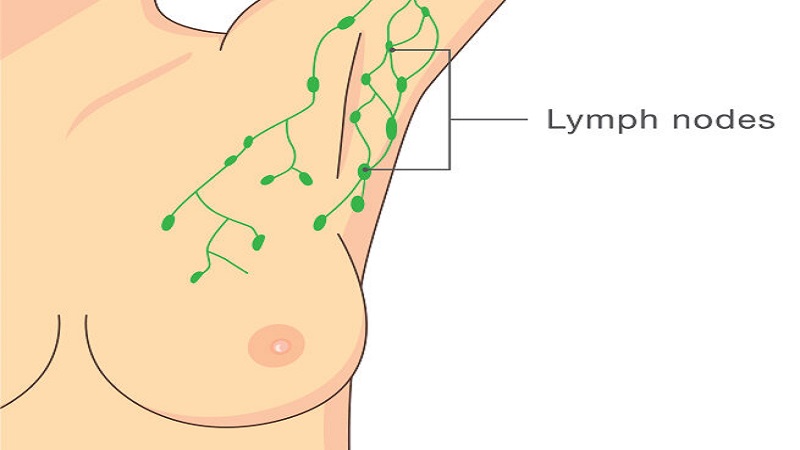 جراح پستان اصفهان | پروتز پستان اصفهان | علت التهاب غدد لنفاوی زیر بغل چیست؟