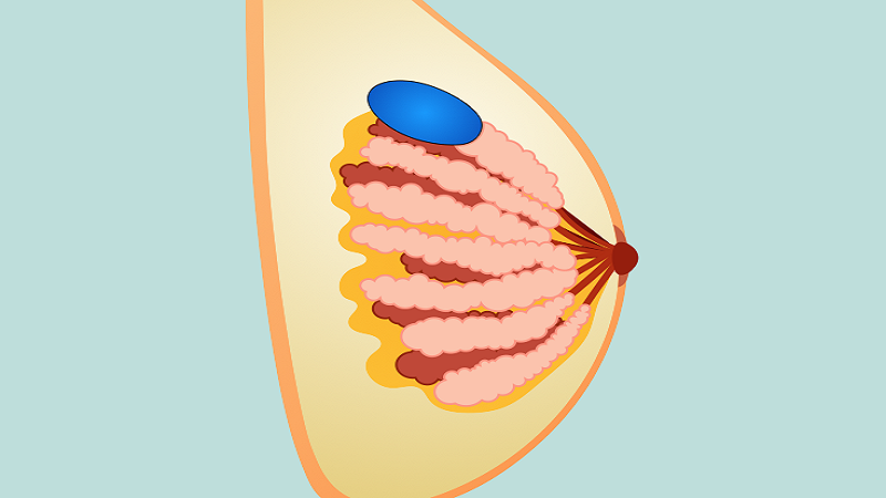 جراح پستان اصفهان | پروتز پستان اصفهان | دکتر رسول فاتحی فرد | آیا کیست­ پستان خودبه ­خود از بین می­ روند؟