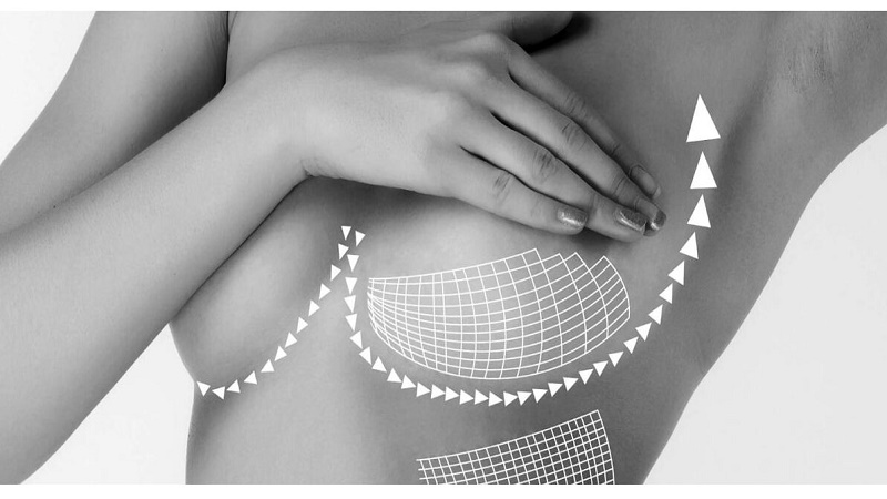 جراح پستان اصفهان | پروتز پستان اصفهان | دکتر رسول فاتحی فرد | انتخاب دکتر لیفت سینه اصفهان