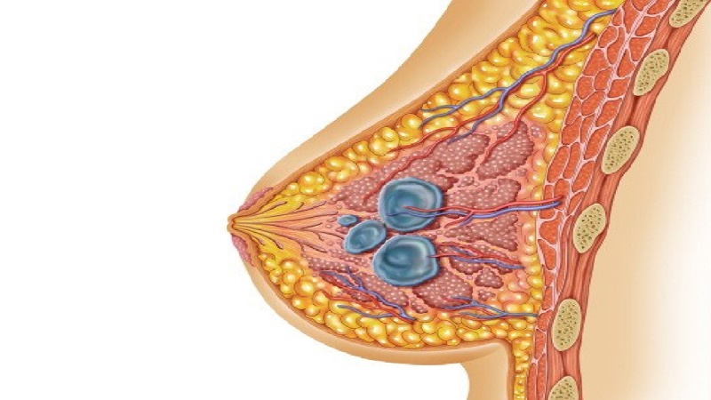 جراح پستان اصفهان | پروتز پستان اصفهان | دکتر رسول فاتحی فرد | کیست سینه کمپلکس
