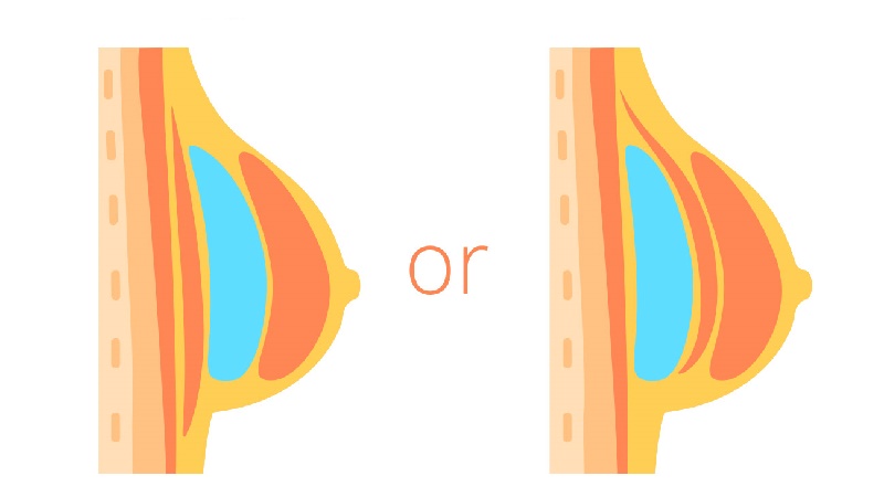 جراح پستان اصفهان | پروتز پستان اصفهان | دکتر رسول فاتحی فرد | جای‌گذاری پروتز پستان در جراحی پروتز سینه